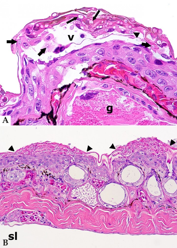 <p>(<strong>A</strong>) Piel; salamandra mandarina (<em>Tylototriton shanjing</em>). Vesícula subcorneal (v) con queratinocitos acantolíticos en una epidermis levemente hiperplásica, en la que se observan numerosos hongos quítridos intralesionales, principalmente talos vacíos que en ocasiones muestran septos internos (“talos coloniales”) (flechas largas), pero también un zooesporangio con esporas basófilas distintivas (cabeza de flecha) y talos uninucleados (flechas gruesas); g: glándula granular de la dermis. Hematoxilina-eosina, x400. (<strong>B</strong>) Piel; rana tomate (<em>Dyscophus guineti</em>). La epidermis muestra hiperplasia con focos de hiperqueratosis y colonización de la queratina por numerosos hongos quítridos (focos delimitados con cabezas de flechas); sl: seno linfático subcutáneo. Hematoxilina-eosina, x240.</p>