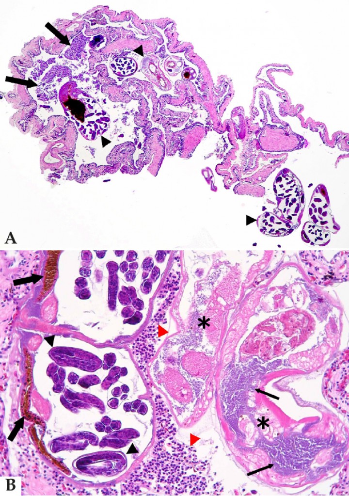 <p>(<strong>A</strong>) Pulmón; rana globo de Madagascar (<em>Scaphiophryne pustulosa</em>). Imagen de bronconeumonía supurativa con exudado (flechas) asociado a la presencia de nematodos en la luz pulmonar (cabezas de flecha) característicos de <em>Rhabdias</em> por el pigmento marrón oscuro en la luz de su intestino y los úteros grávidos con larvas en desarrollo. Hematoxilina-eosina, x40. (<strong>B</strong>) Mismo caso que Fig. 8A. A mayor aumento, se observa el exudado purulento (cabezas de flecha rojas) alrededor de secciones de nematodos con pigmento marrón oscuro en la luz de su intestino (flechas gruesas) y los úteros grávidos con larvas en desarrollo (cabezas de flecha negras), característicos de <em>Rhabdias</em>. Dos de los nematodos están necróticos (asteriscos) y colonizados por abundantes bacterias (flechas delgadas). Hematoxilina-eosina, x400.</p>