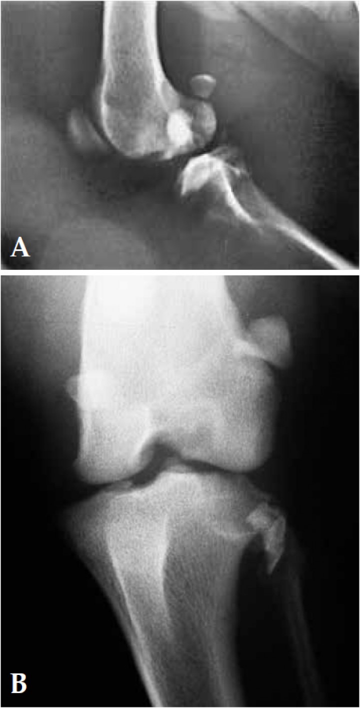 <p>A. Radiografía lateral y B. Radiografía posteroanterior de la articulación de la rodilla izquierda en el momento de la presentación. Se observa una subluxación articular y un pequeño fragmento óseo desplazado lateralmente procedente de una fractura en el área medial del surco del tendón del músculo extensor digital largo de la cara lateral de la epífisis proximal de la tibia izquierda.</p>
