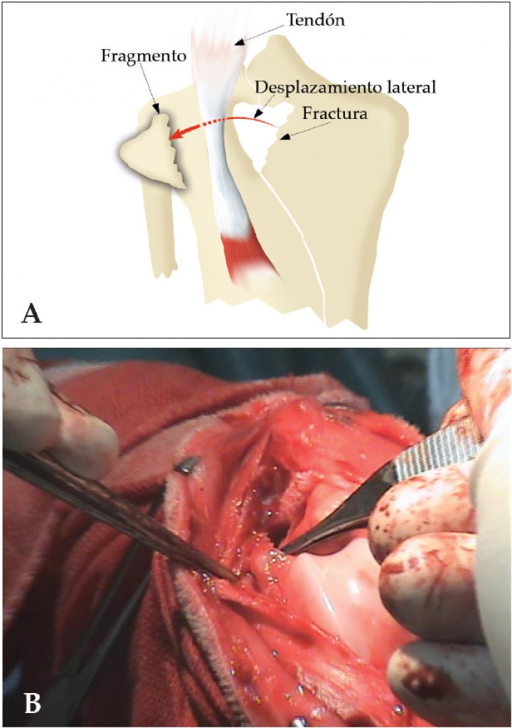 <p>A. Esquema del fragmento desplazado. B. Imagen macroscópica del fragmento.</p>