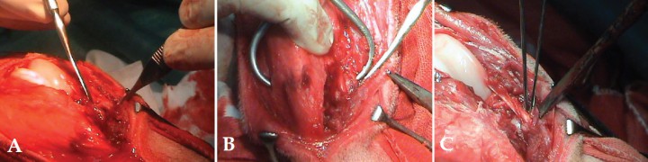 <p>A.Colocación del fragmento en el lugar original. B. Sujeción del fragmento con fórceps en el lugar original. C.Fragmento fijado con dos agujas.</p>