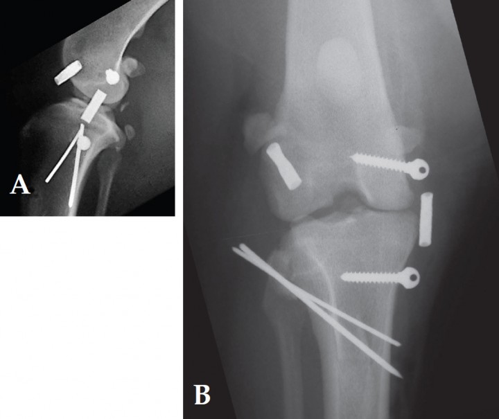 <p>Radiografías postoperatorias. A. Proyección lateral B. Proyección postero-anterior.</p>