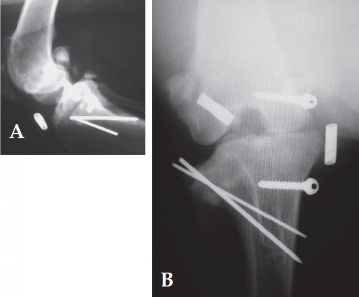 <p>Radiografías realizadas 6 meses después de la cirugía. A. Proyección lateral. B. Proyección postero-anterior.</p>