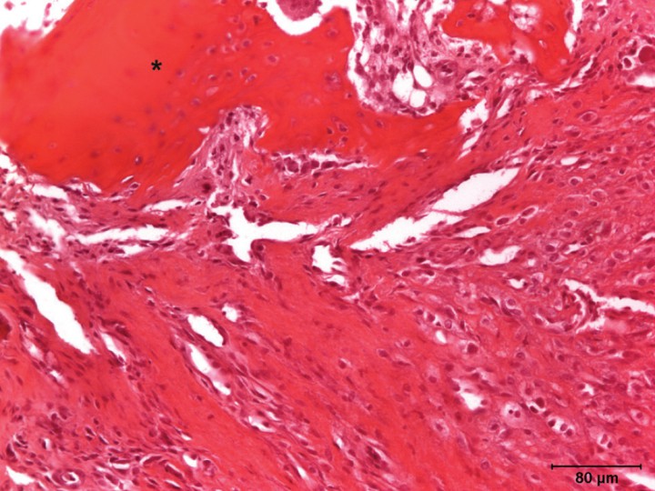 <p>Imagen microscópica de la epífisis proximal del fémur. Se aprecia la presencia de un tejido conectivo denso muy rico en fibroblastos que sustituye al tejido óseo típico. En la parte superior (asterisco) se observa el resto de una espícula ósea aparentemente normal (Hematoxilina & Eosina).</p>