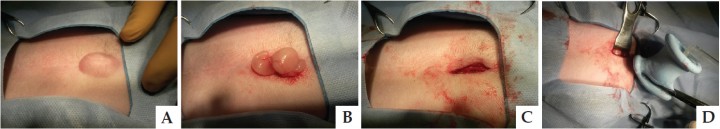 <p>A) Aspecto de la hernia umbical. B) Resolución quirúrgica. C) Aspecto final de la hernia umbilical. D) Introducción del dispositivo multicanal de incisión única.</p>