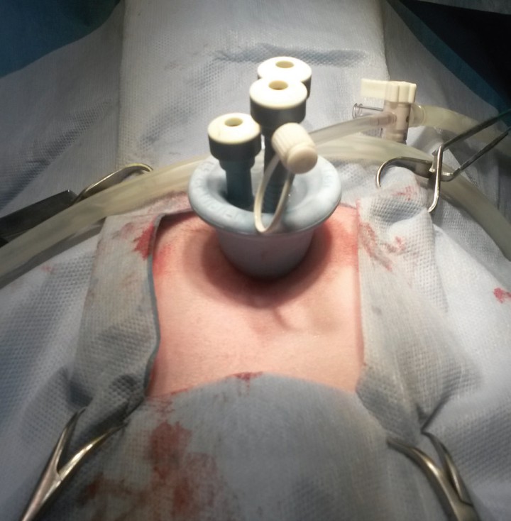 <p>Aspecto final del dispositivo de incisión única con sus cánulas de acceso.</p>