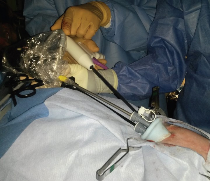 <p>Maniobras durante el abordaje por LESS para el tratamiento de criptorquidia abdominal.</p>