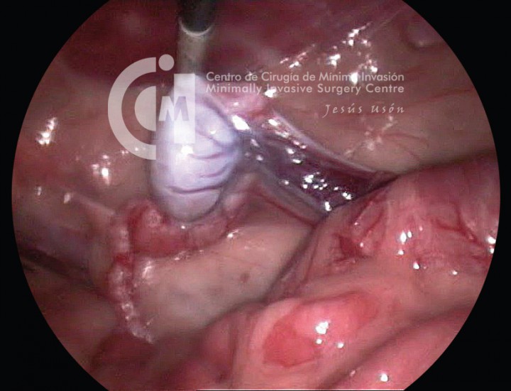 <p>Visión endoscópica durante la localización del testículo intraabdominal.</p>