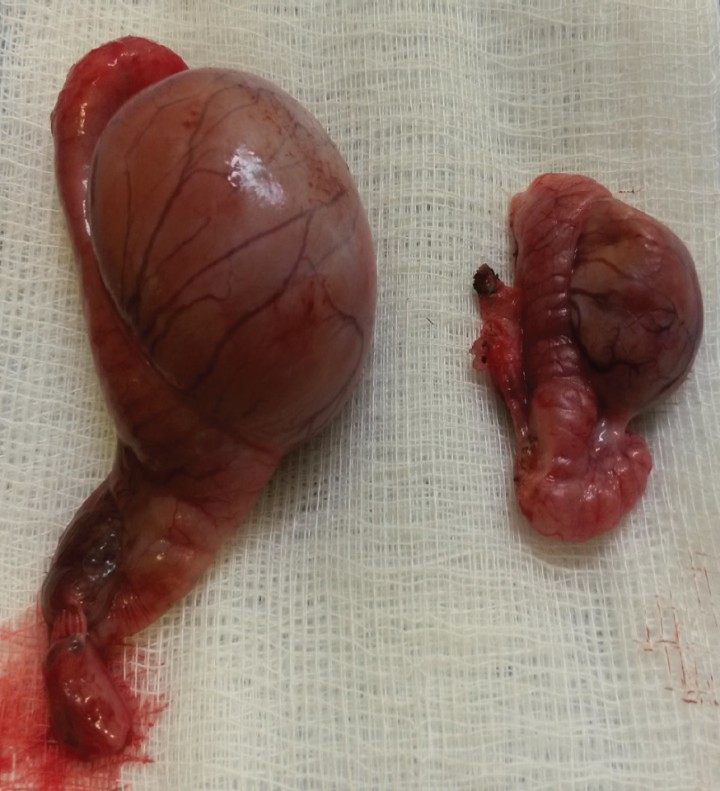 <p>Diferencia de tamaño de testículo escrotal e intraabdominal.</p>