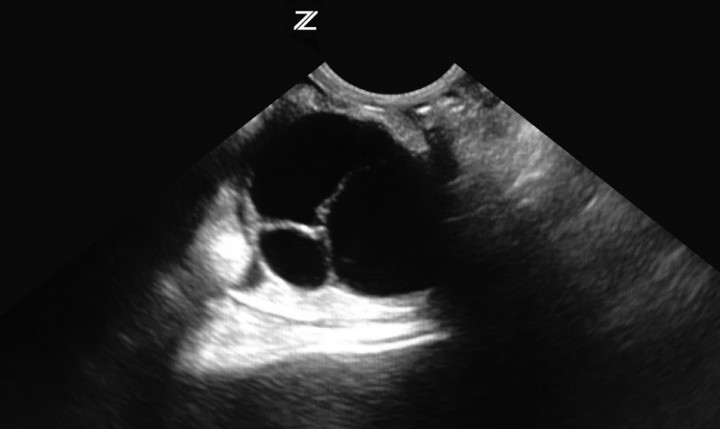 <p>Quiste ovárico izquierdo (caso 1).</p>