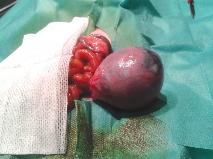 <p>Quiste ovárico parcialmente vacío (caso 1).</p>