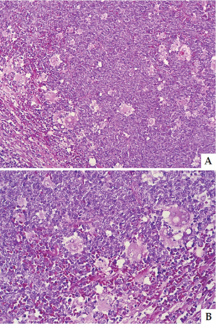 <p>Linfoma Hodgkin like células uni, bi, multinucleadas. Tinción Hematoxilina y Eosina x 20 (A) y x 40 (B) aumentos.</p>