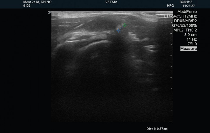 <p>Corte sagital del tendón del músculo supraespinoso izquierdo en el que se muestra la mineralización (entre los cursores) como una superficie ecogénica irregular con sombra acústica posterior.</p>