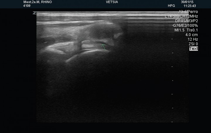 <p>Corte sagital del tendón del músculo bíceps braquial izquierdo en el que se muestra una ligera distensión de la vaina sinovial y engrosamiento de la membrana sinovial.</p>