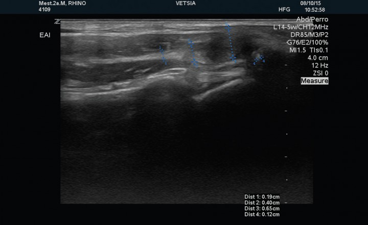 <p>Corte sagital del tendón del músculo supraespinoso izquierdo posterior al tratamiento, en el que se observa disminución de la mineralización del tendón (medida número 4).</p>