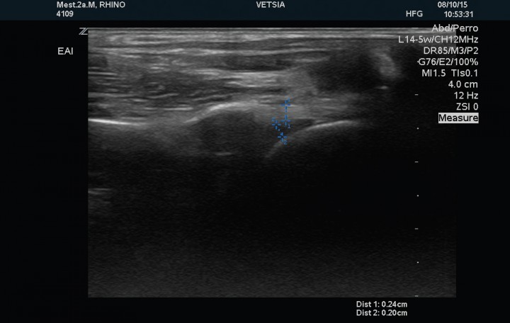 <p>Corte sagital del tendón del músculo bíceps braquial izquierdo sin distensión de la vaina, mostrándose ecográficamente normal.</p>