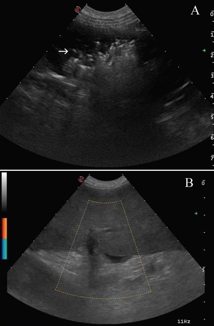 <p>Imagen ecográfica del bazo. (A) Se visualiza hipoecogénico con áreas hiperecogénicas asociadas al artefacto de reverberación sugiriendo la presencia de gas intraparenquimatoso. (B) Al aplicar el Doppler-color, no se aprecia vascularización.</p>
