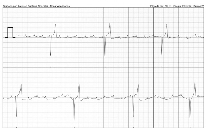 <p>Presencia de ondas P no conducidas, con intervalo P-R no constante y frecuencia ventricular de 28 lpm. Bloqueo auriculoventricular de 3º grado.</p>