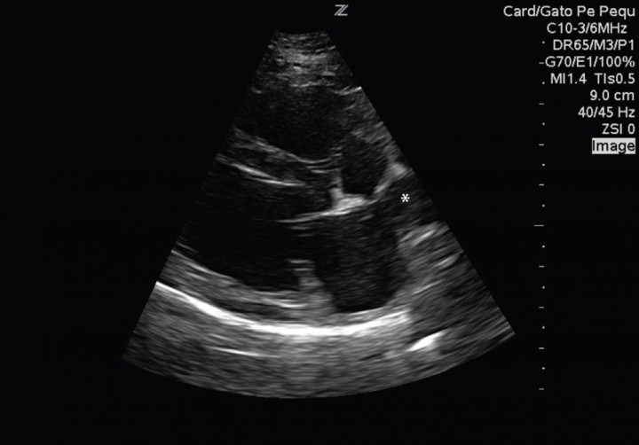 <p>Corte paraesternal derecho eje largo, donde se observa una dilatación de la vena pulmonar (*) sin detectarse aumento del atrio izquierdo.</p>