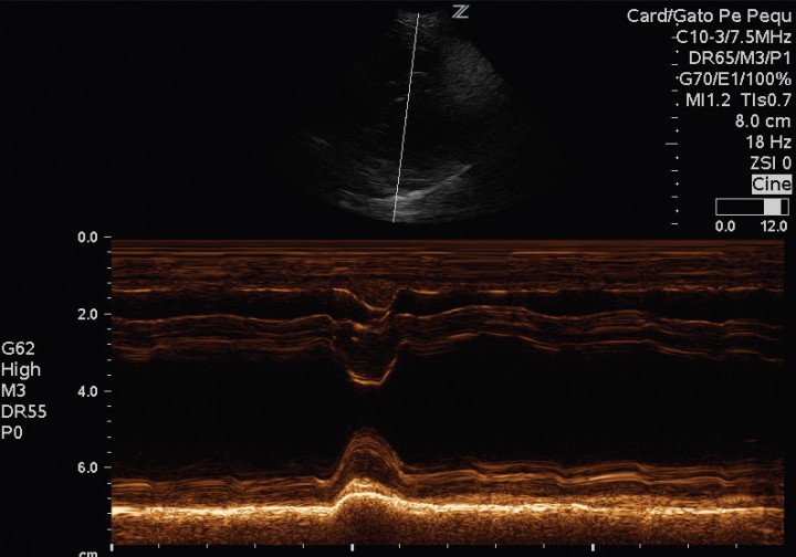 <p>Modo M sobre músculos papilares en paraesternal derecho eje corto. Se observa una fracción de acortamiento mantenida, con espesores de septo interventricular y pared libre ventricular izquierda correctos.</p>
