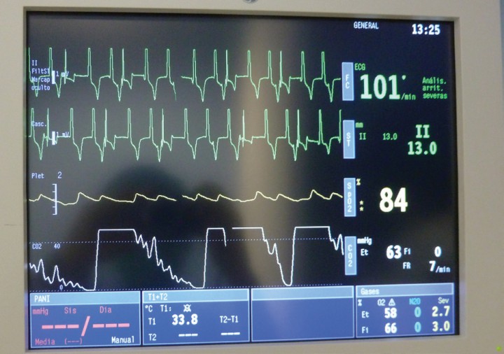 <p>Al momento de la implantación del cable ventricular y conexión del electrodo al marcapasos, se observa un ritmo ventricular con morfología del lado derecho a la velocidad establecida en el marcapasos, esto indica la correcta colocación del electrodo ventricular.</p>