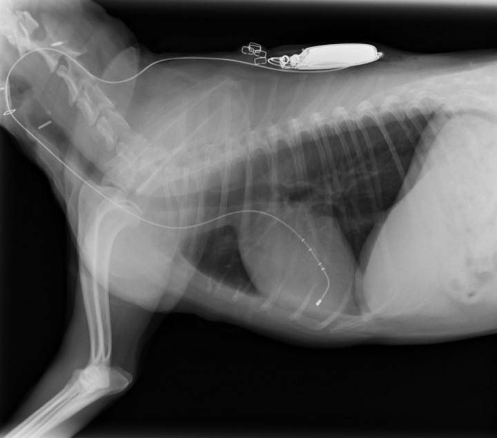 <p>Se observa una disminución en el tamaño de la silueta cardiaca (medición de índice de Buchanan), con una correcta colocación del electrodo ventricular derecho.</p>