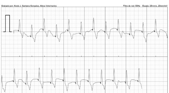 <p>Electrocardiograma postimplantación con una frecuencia cardiaca de 100 lpm.</p>