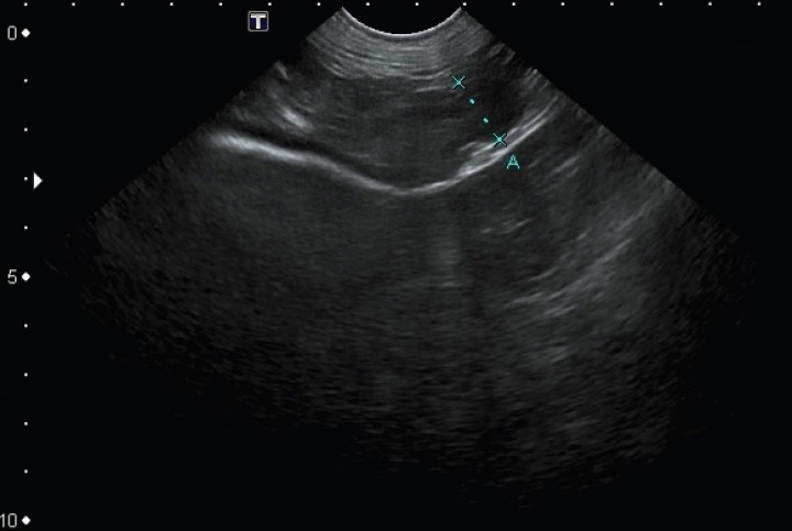 <p>Imagen ecográfica en la que observamos la masa encapsulada hipoecogénica de 2,23 x 4,74 cm.</p>