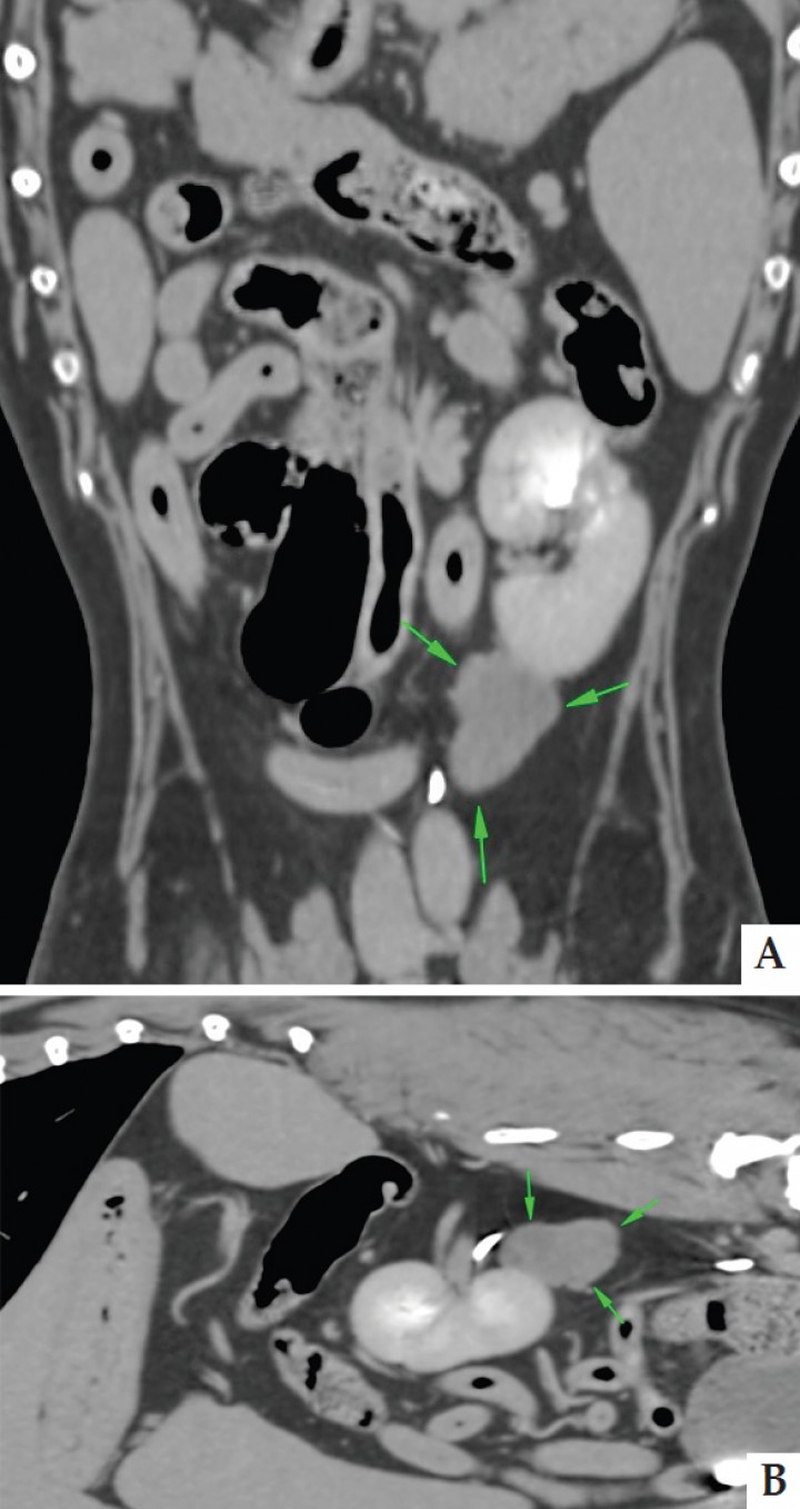 <p>Imágenes de tomografía computerizada post-contraste: A. Reconstrucción dorsal. B. Reconstrucción sagital en ventana de tejido blando en fase arterial, donde se observa la localización caudo-medial de la masa en contacto con el polo caudal del riñón izquierdo.</p>