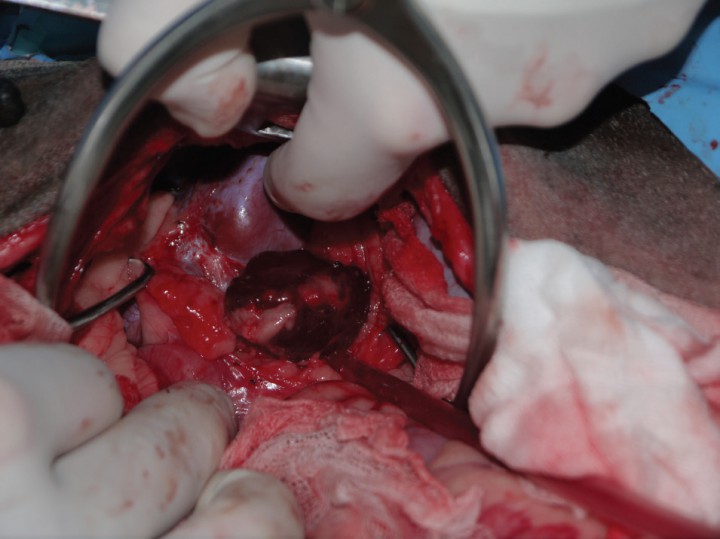 <p>Imagen quirúrgica intraoperatoria tras la apertura del retroperitoneo y localización de la masa.</p>