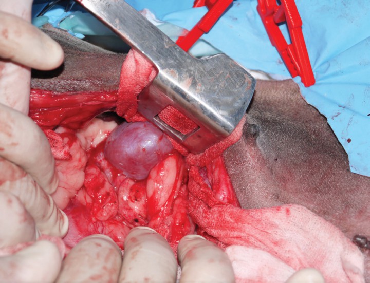 <p>Imagen quirúrgica intraoperatoria de la zona donde se situaba el tumor justo después de la extirpación completa de la masa retroperitoneal.</p>