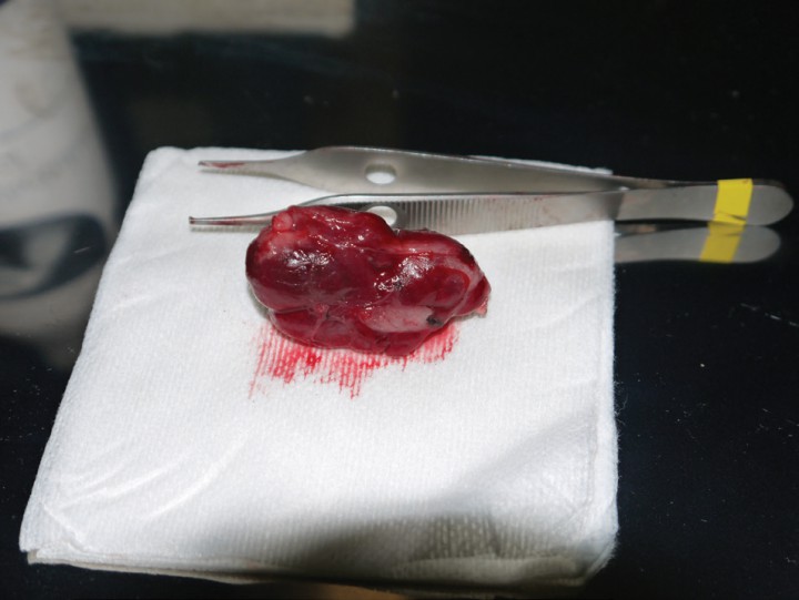 <p>Aspecto macroscópico de la masa retroperitoneal ya extirpada.</p>