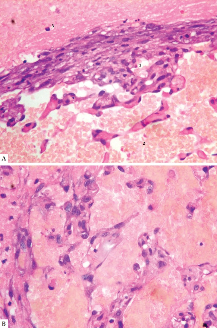 <p>Células endoteliales de pleomorfismo moderado, mostrando núcleo redondo u ovoide con anisocariosis moderada (1), formando luces vasculares irregulares con abundante número de eritrocitos (2) y escasa cantidad de fibrina, plasma y leucocitos (3). Hematoxilina & Eosina. 400x.</p>