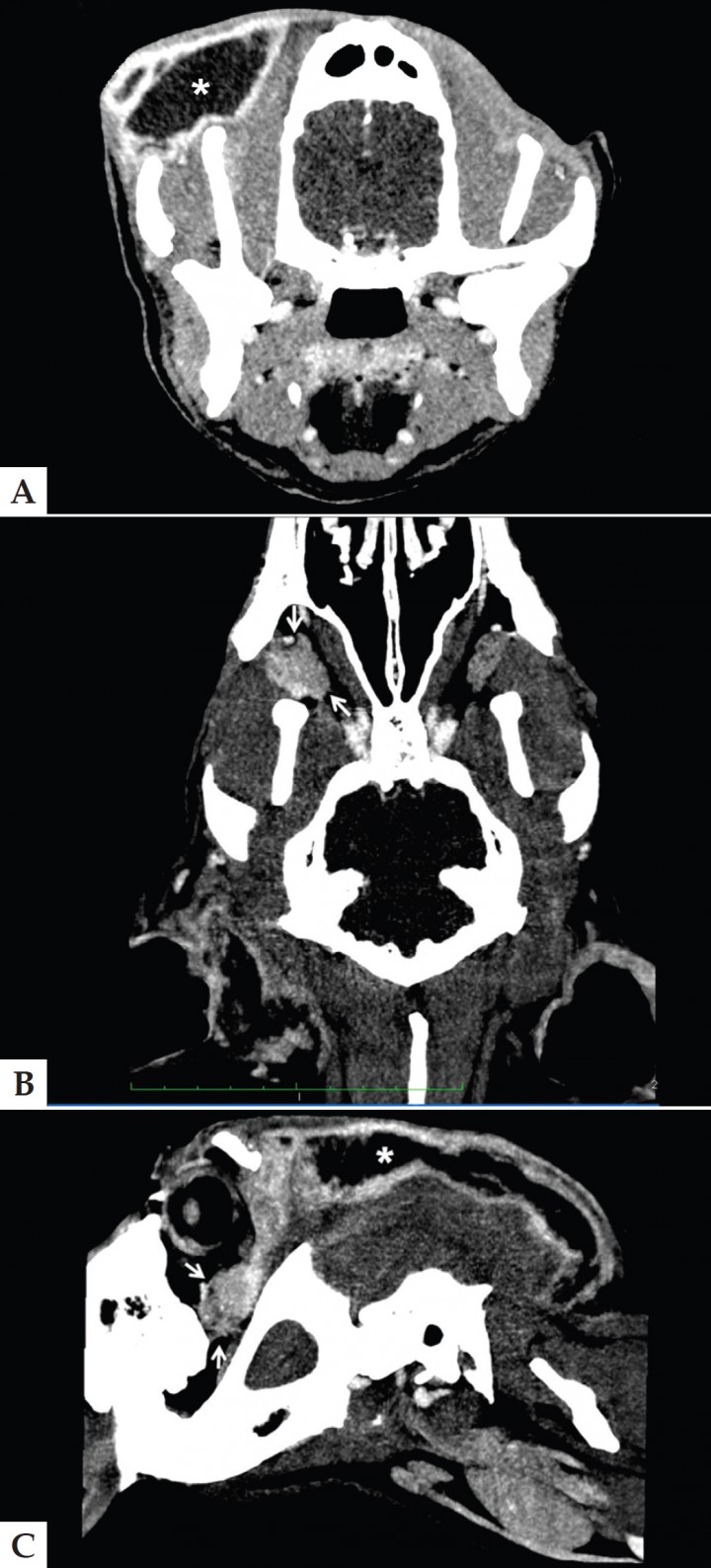 <p>Imagen de tomografía computarizada postcontraste el día de la visita (A. Axial; B. Dorsal; C. Parasagital) en la que se observa un aumento de tamaño de la glándula cigomática derecha (flecha) con captación de contraste marcada y heterogénea que se comunica con un acúmulo de material hipodenso subcutáneo bien encapsulado que se extiende desde la región frontal hasta la occipital (*). Ancho de ventana 142 UH. Centro de ventana 95 UH.</p>