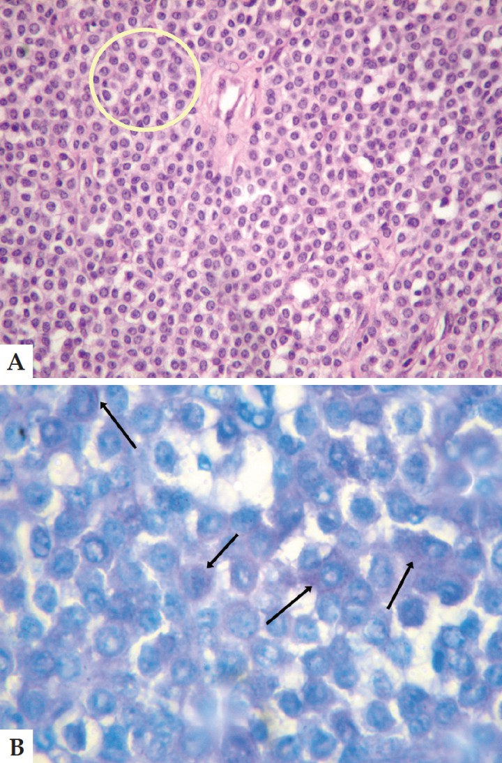 <p>A. Corte histológico. Conjunto de células redondas características del proceso (círculo amarillo). Tinción Hematoxilina-Eosina Aumento 40x. B. Corte histológico. Tinción con azul de toluidina, donde es posible apreciar abundantes gránulos metacromáticos (flechas). Aumento 1000x.</p>