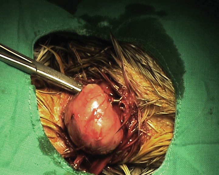 <p>Aspecto de la masa en el momento de la extracción quirúrgica.</p>