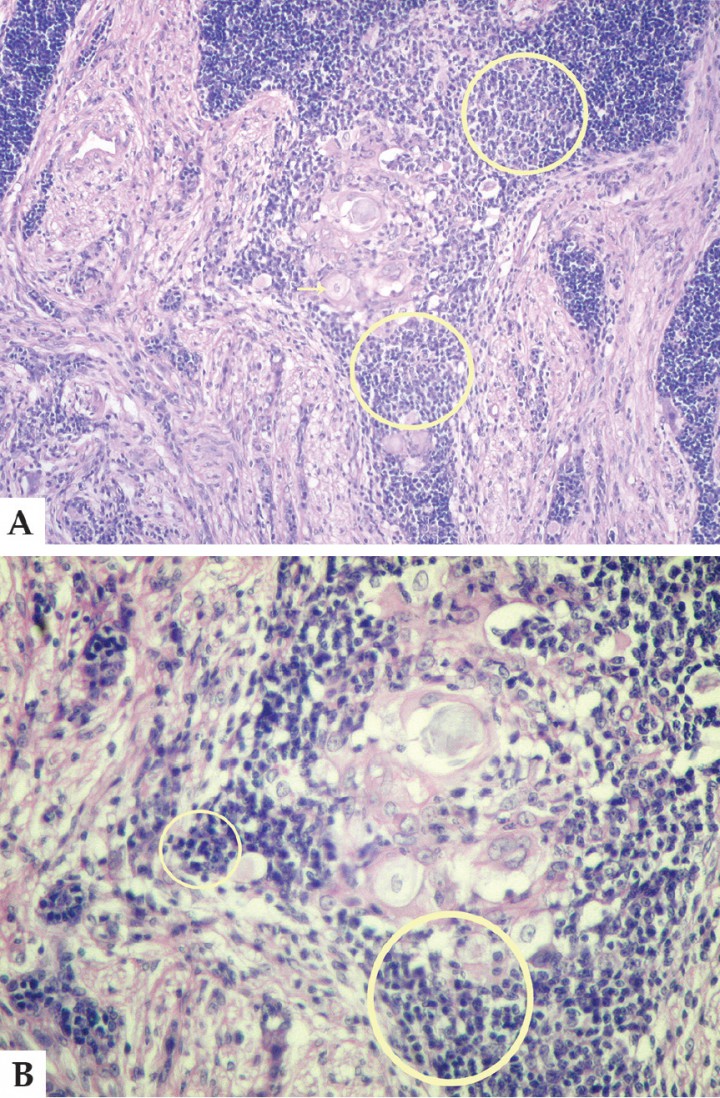 <p>A. Corte histológico. Población celular mixta (círculo amarillo) compuesta de elementos linfocíticos maduros y células epiteliales grandes, poligonales o alargadas, de citoplasma claro y formación ocasional de corpúsculos de Hassal (flecha). Aumento 40x. Tinción Hematoxilina-Eosina. B. Corte histológico. Imagen a 400x donde se observa dentro de un círculo amarillo, la población celular mixta mencionada en la imagen anterior (A). Tinción Hematoxilina-Eosina.</p>