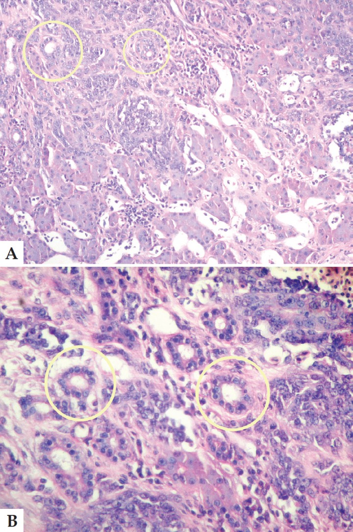 <p>A. Corte histológico. Tejido hepático infiltrado por células atípicas poliédricas con escaso citoplasma y anisocariosis. Los conductos con características neoplásicas indican el origen del cambio tumoral (círculo). Aumento 40x. B. Corte histológico. Es posible apreciar que las células presentan citoplasma acidófilo, núcleos vesiculares con 1–2 nucléolos evidentes (círculo). Aumento 400x. Tinción Hematoxilina-Eosina.</p>
