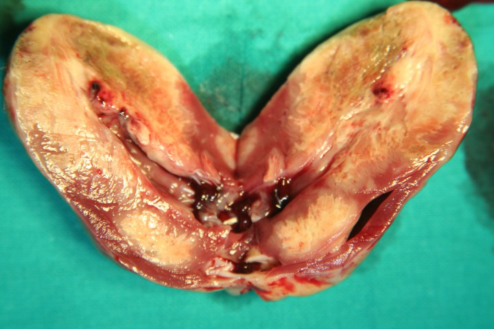 <p>Un corte longitudinal del corazón pone en evidencia el contraste entre el tejido miocárdico sano y el afectado por la neoplasia.</p>