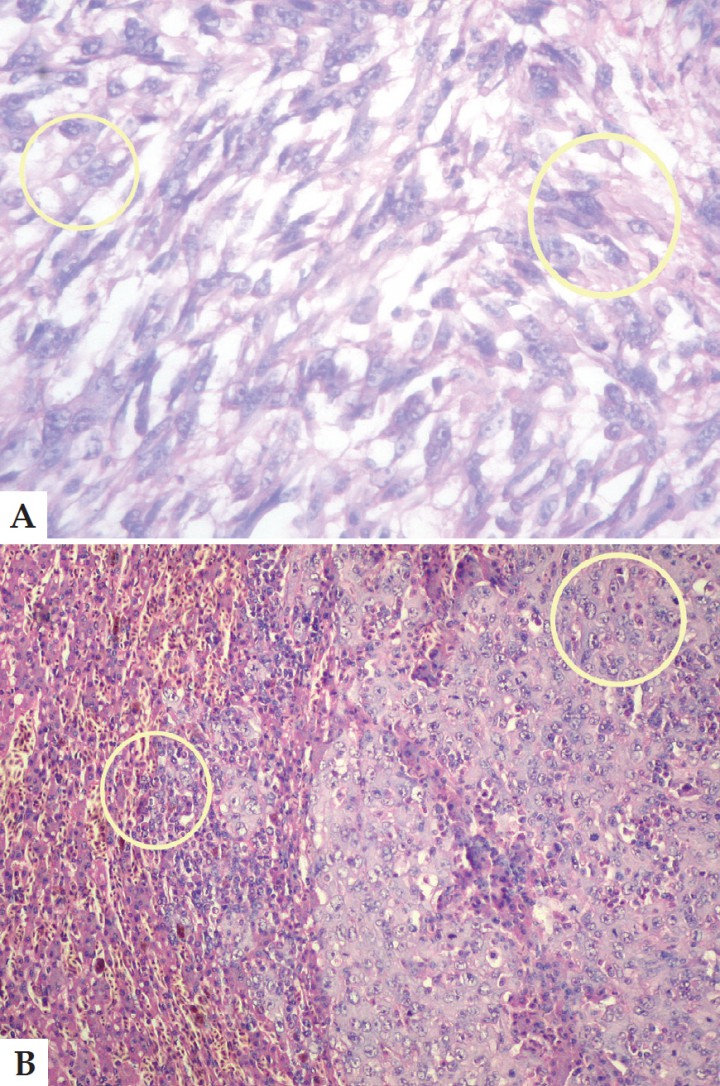 <p>A. Corte histológico. El objetivo de inmersión ayuda a identificar células fusiformes, pleomórficas (círculo), que permiten confirmar un sarcoma. Aumento 1000x. Tinción Hematoxilina-Eosina. B. Corte histológico. El círculo superior derecho marca la neoplasia y el de la izquierda y abajo, la infiltración de las células sobre el parénquima hepático. Aumento 40x. Tinción Hematoxilina-Eosina.</p>