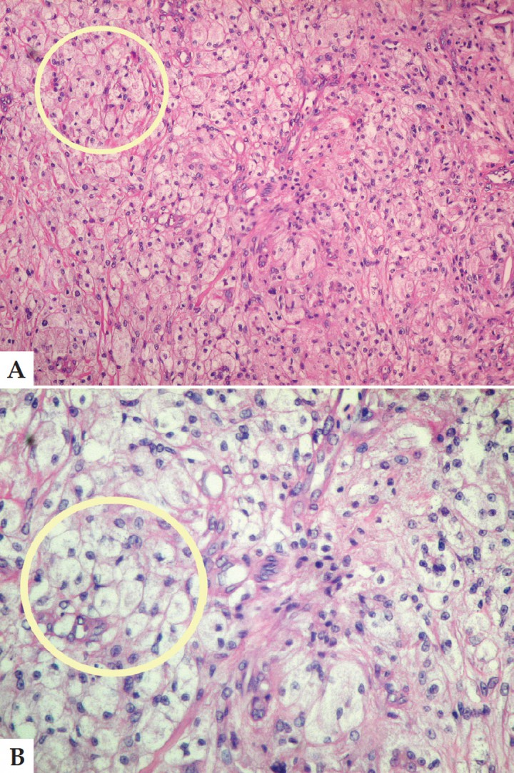 <p>A. Corte histológico. Infiltración difusa de macrófagos con citoplasma vacuolizado (círculo). Aumento 40x. Tinción Hematoxilina-Eosina. B. Corte histológico. Detalle de los macrófagos con citoplasma acidófilo claro y espumoso (lipídico) característicos de esta lesión (círculo). Aumento 400x. Hematoxilina-Eosina.</p>