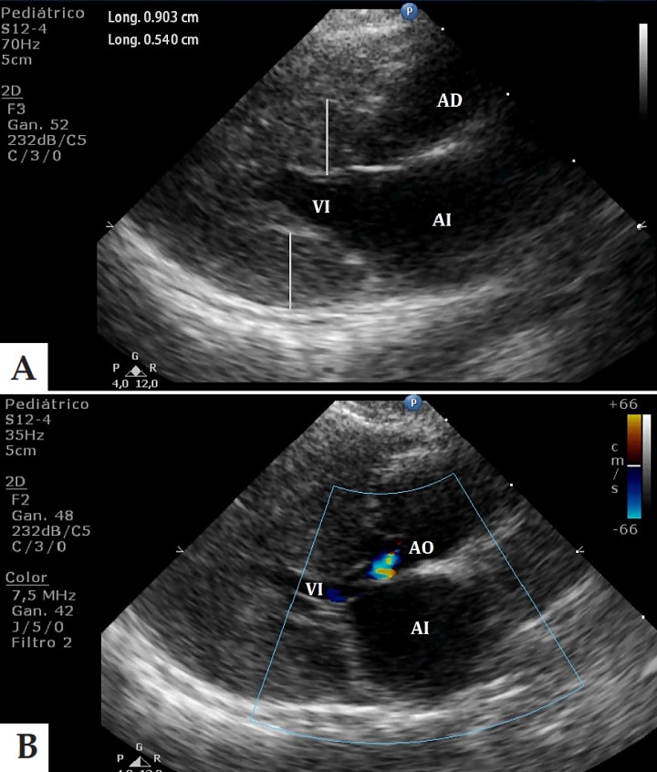 <p>A: Imagen ecocardiográfica en un corte paraesternal derecho en eje largo donde se aprecia la hipertrofia de las paredes del ventrículo izquierdo (AI: aurícula izquierda; VI: ventrículo izquierdo; AO: aorta). B: Imagen ecocardiográfica en modo Doppler color en un corte paraesternal derecho en eje largo donde se observa regurgitación en la válvula aórtica debida a la hipertensión sistémica (AI: aurícula izquierda; VI: ventrículo izquierdo; AD: aurícula derecha).</p>