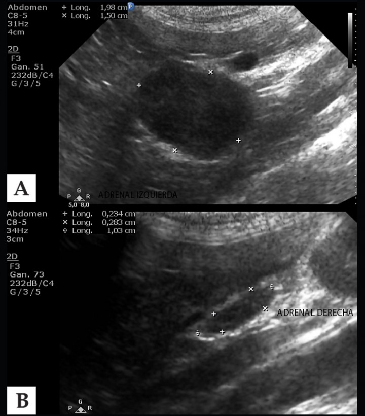 <p>A: Imagen ecográfica de la glándula adrenal izquierda que refleja aumento de tamaño con aspecto neoplásico. B: Imagen ecográfica de la adrenal derecha de tamaño y aspecto normal.</p>