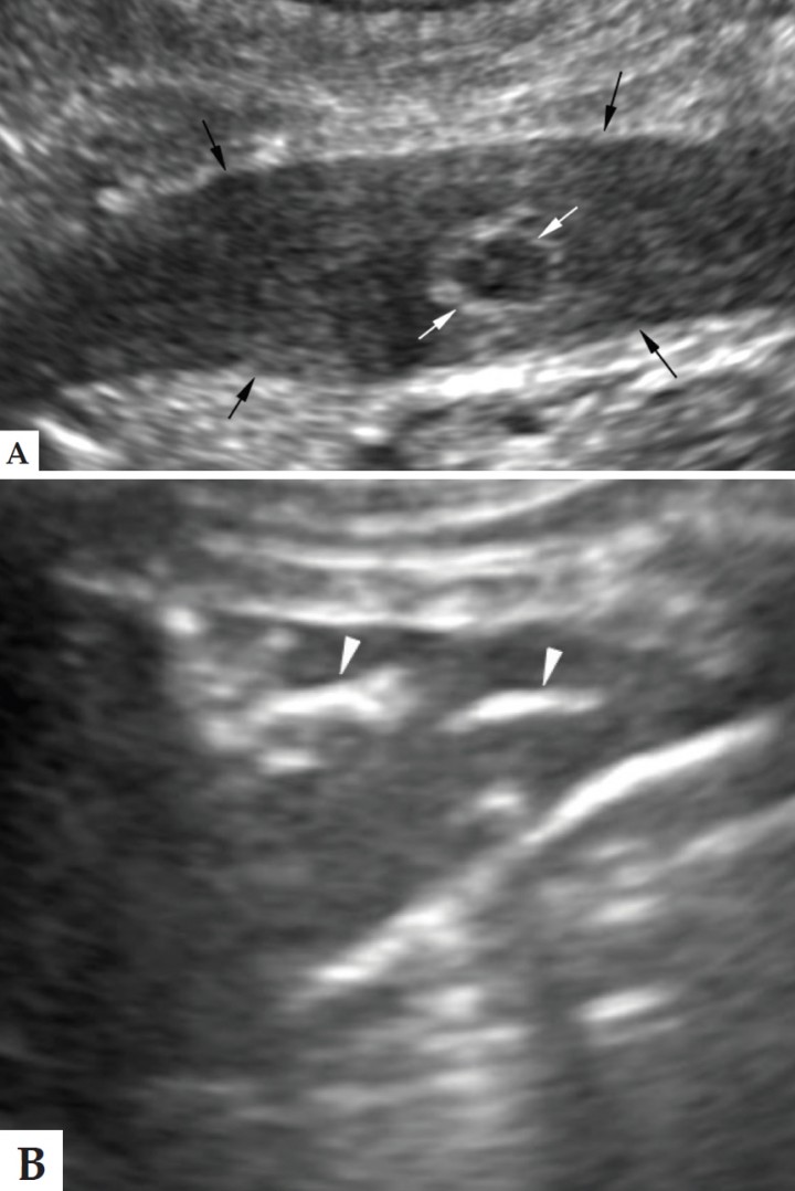 <p>Imágenes ecográficas del lóbulo pulmonar craneal izquierdo consolidado (flechas negras) con un broncograma líquido señalado por la flecha blanca (A) y con broncogramas aéreos señalados por las puntas de flecha blancas (B).</p>