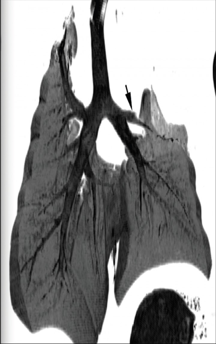 <p>Reconstrucción multiplanar dorsal de mínima intensidad (minIP). La flecha negra señala la terminación abrupta de la porción craneal del bronquio principal del lóbulo pulmonar craneal izquierdo.</p>