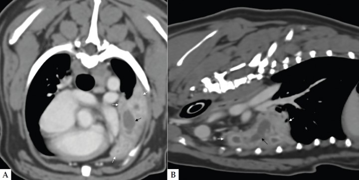 <p>Imágenes de TC de tórax en los planos axial (A) y sagital (B) y ventana de tejido blando. El lóbulo pulmonar craneal izquierdo está completamente consolidado (flechas blancas), excepto por una pequeña zona en la parte caudal que permanece aireada. Distal a la terminación abrupta del bronquio principal izquierdo se observa una estructura tubular rellena de líquido dentro del pulmón consolidado (flecha negra). Esto es compatible con el árbol bronquial dilatado y relleno de líquido.</p>