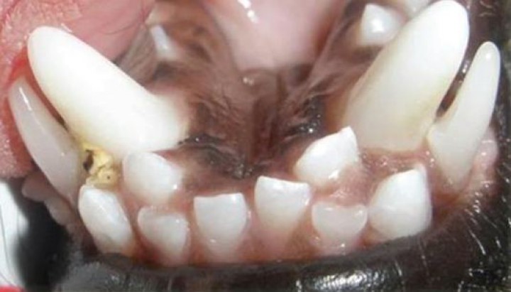 <p>Persistencia de dentadura decidua. Apréciense los dientes caninos deciduos inferiores, vestibulares a los dientes caninos definitivos, y los incisivos definitivos centrales que han erupcionado linguales a los deciduos.</p>