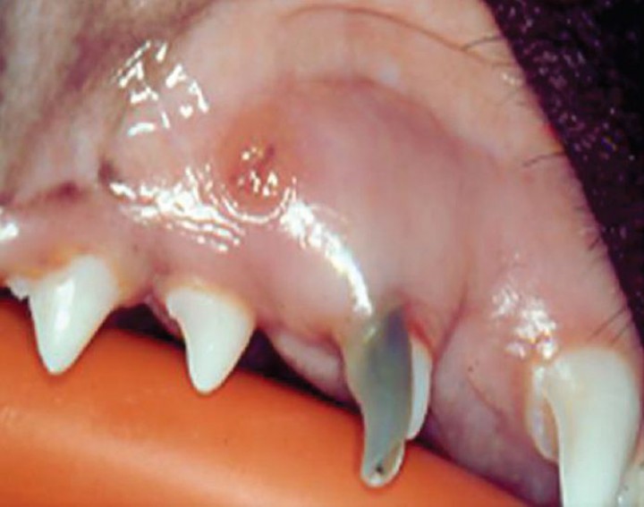 <p>Fractura coronal complicada del canino deciduo superior izquierdo (504). Nótese la exposición y necrosis de la pulpa, el cambio de coloración, y la aparición de una fístula en la zona apical.</p>