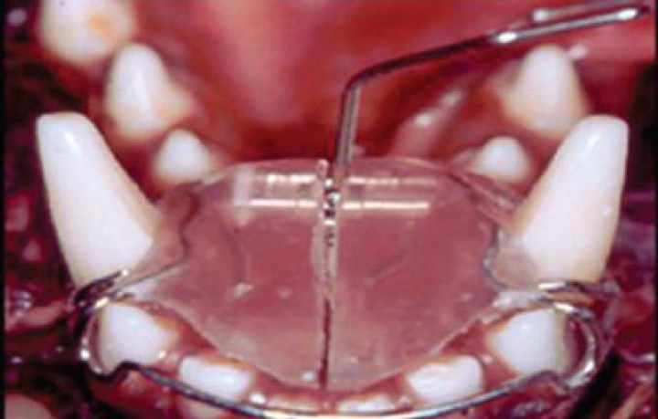 <p>Movimiento ortodóncico del diente. Placa partida con tornillo de expansión para resolver la lingualización de los caninos mandibulares en un perro.</p>