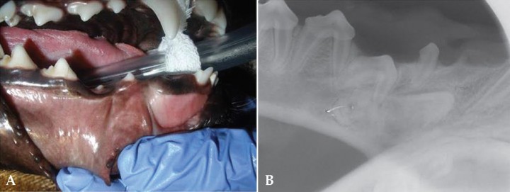 <p>A. Se observa la ausencia del canino inferior derecho (404). El segundo premolar inferior derecho (406) no ha erupcionado completamente. B. Radiografia lateral oblicua de la mandíbula. Se aprecia la presencia de un quiste dentígero secundario a un diente no erupcionado (impactado o incluido).</p>